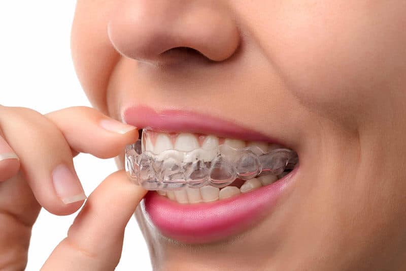 Can Anyone Get Clear Braces? - Metro Smiles Dental Forest Hills New York